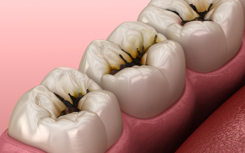 Reasons behind tooth decay
