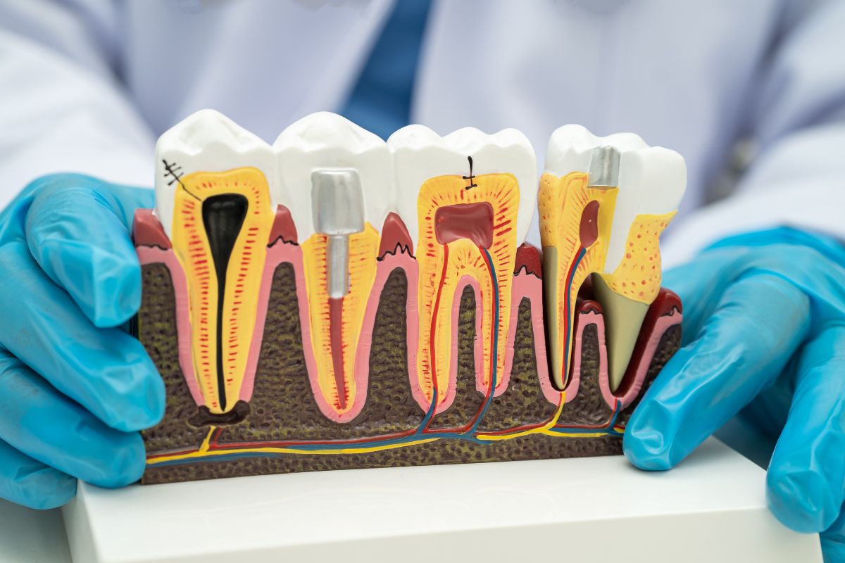 Dental Implant Seattle