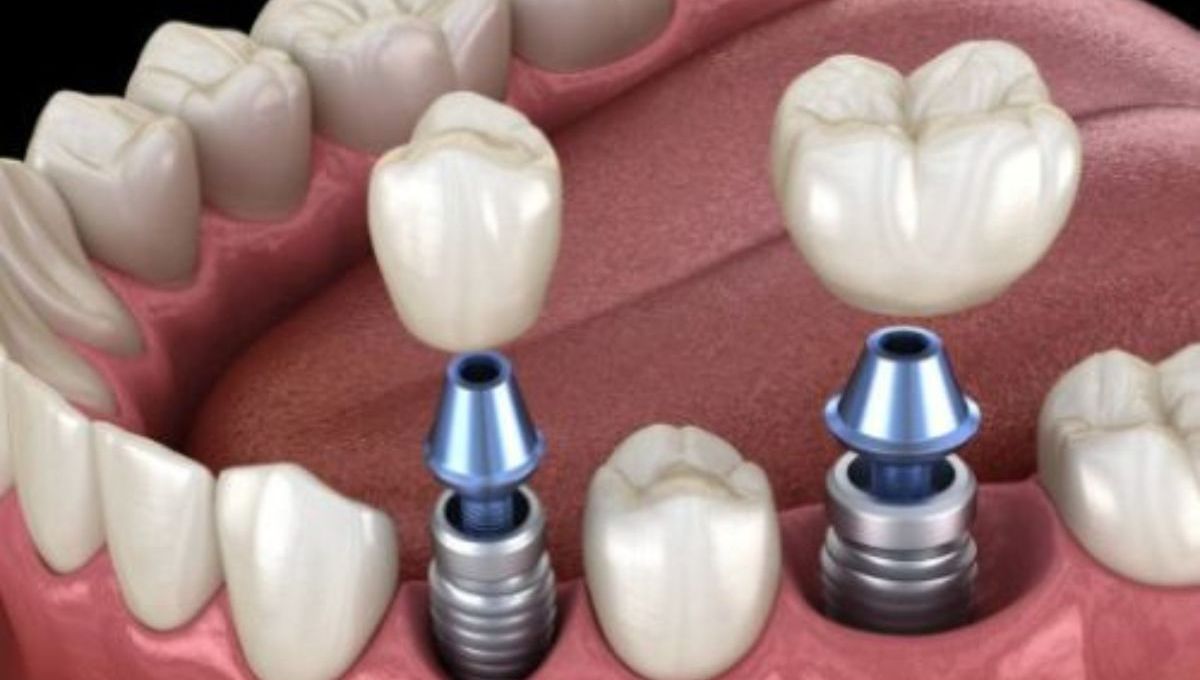 Dental Implants for Diabetic patient in Seattle
