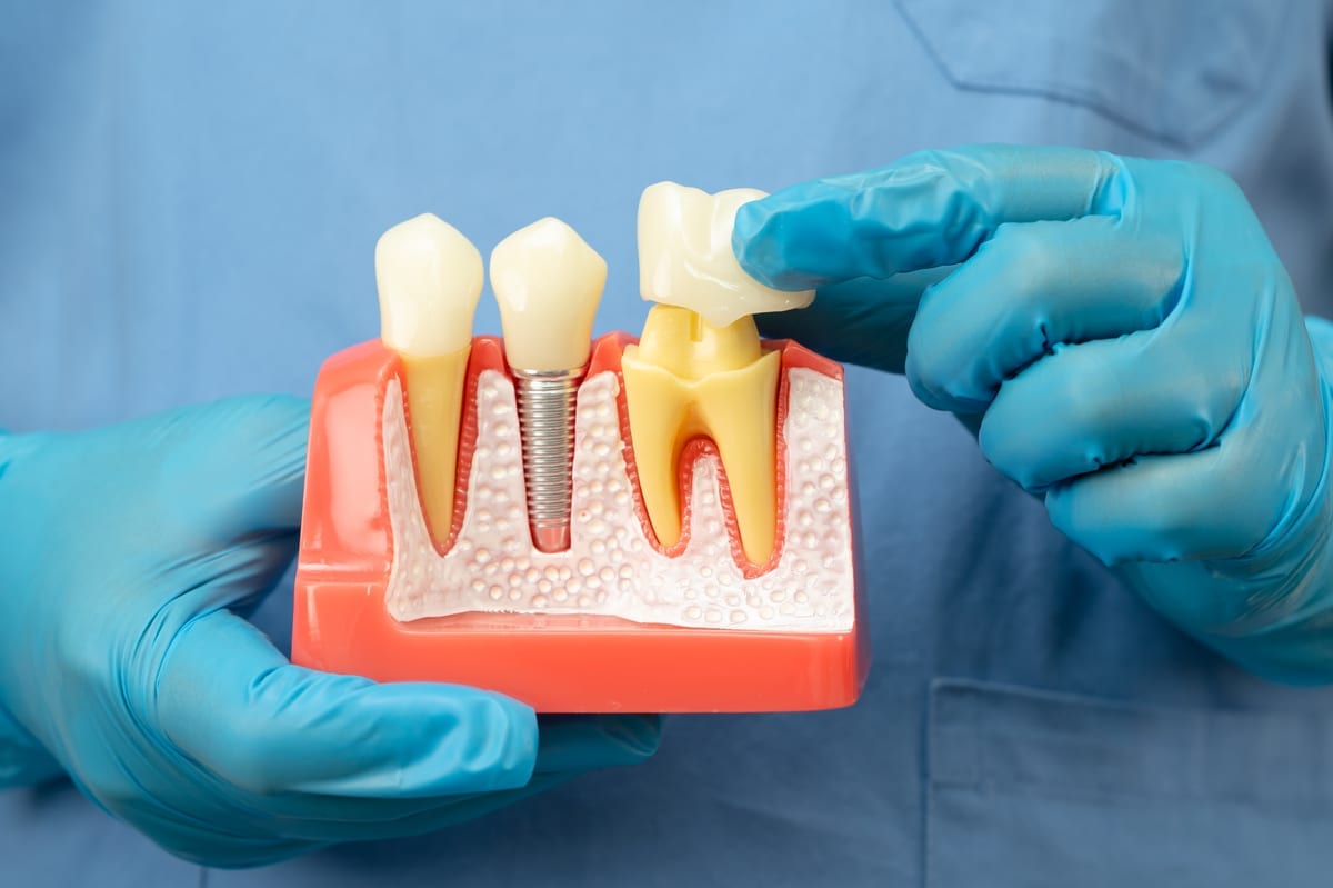 Dental Crowns in Burien