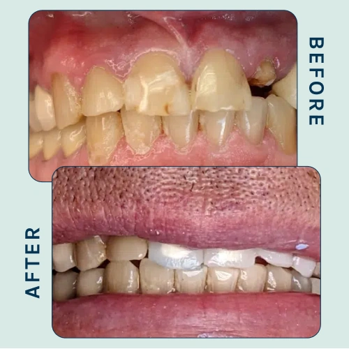 Braces Treatment