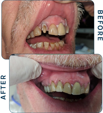 Before-and-after smile of a patient with severely broken and misaligned teeth restored to a healthier and more uniform smile.