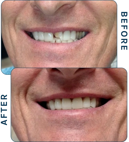 Before-and-after smile showing a damaged tooth repaired with a CEREC crown, resulting in a natural and aligned tooth.