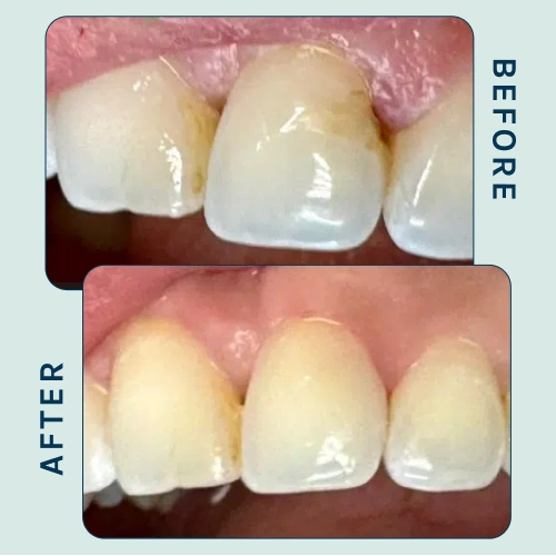 Chipped Tooth Repair