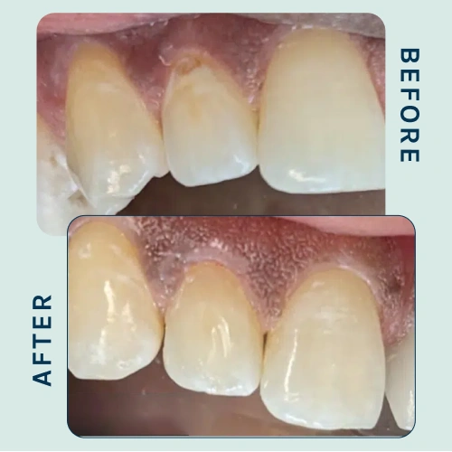 Composite Bonding