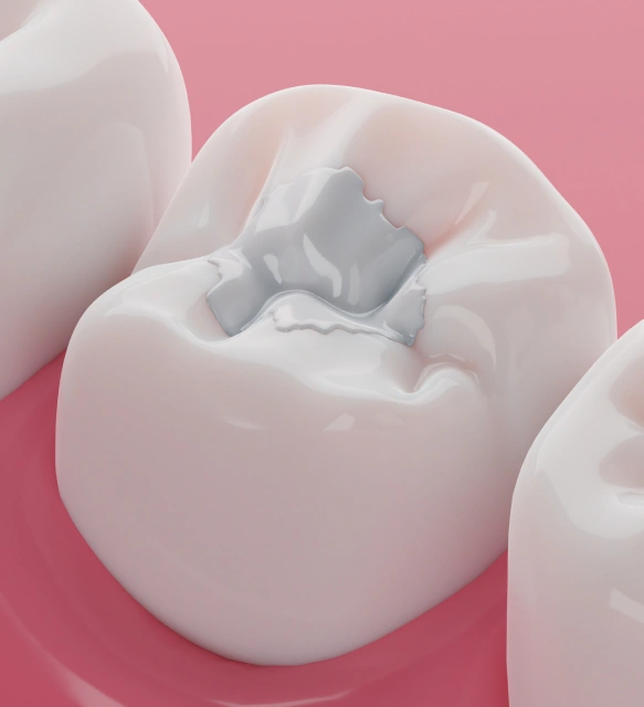 What Are Composite Fillings?