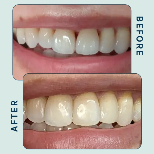 Cosmetic Smile-Transformation