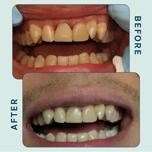 Dental Bridge