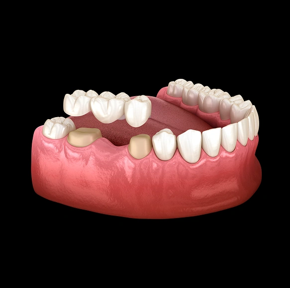 What Is a Dental Bridge?