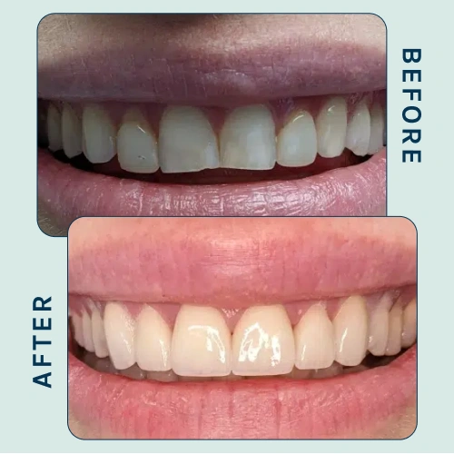 Dental Crown