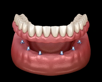 Implant-Supported Dentures