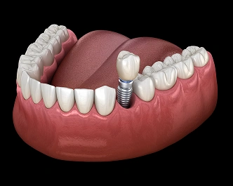Single Tooth Implants