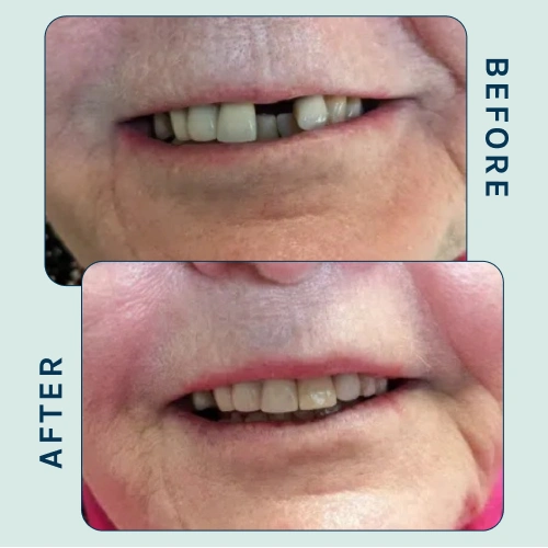 Dental Implants