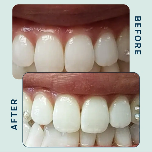 Dental Veneers