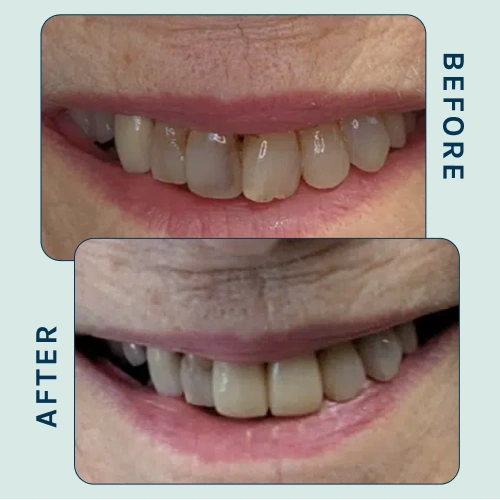 Front Teeth-Restoration