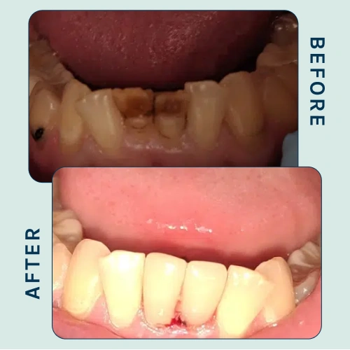 Full Mouth Rehabilitation