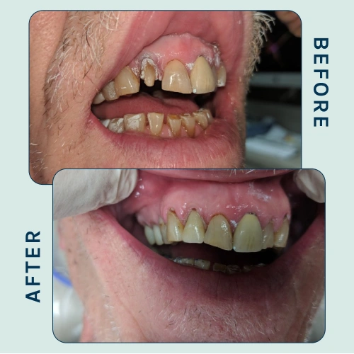 Full Mouth-Restoration