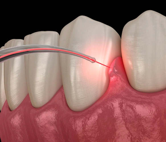 What Is Laser Dentistry?