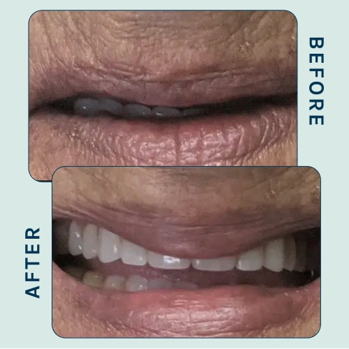 Lip Enhancement smile