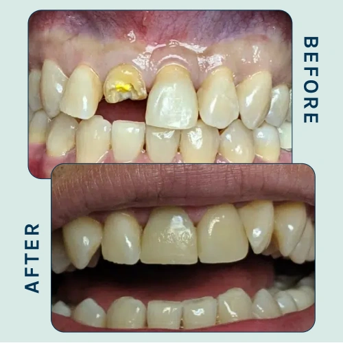 Orthodontic Treatment