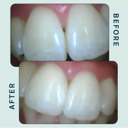 Porcelain Veneers