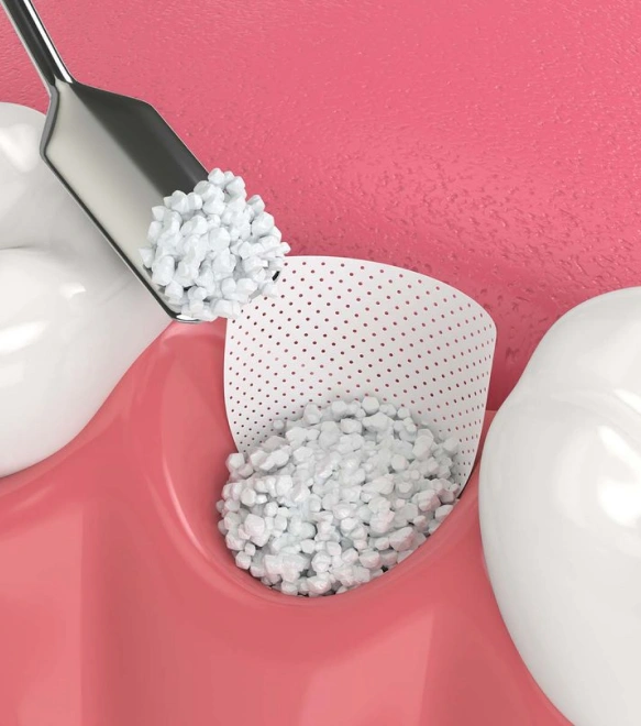 Restoring the Shape and Strength of Your Jaw