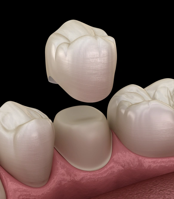 A Permanent Crown in One Visit