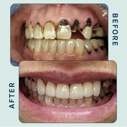 Dentures