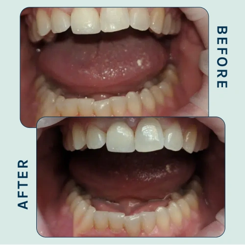 Smile Makeover
