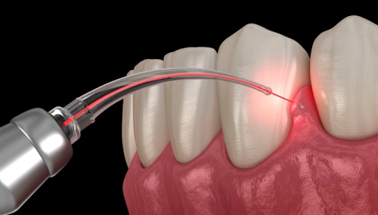 Laser Dentistry