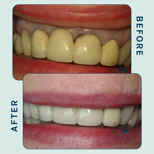 teeth whitening Result