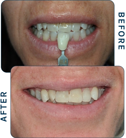 Before-and-after smile showing a patient with a discolored front tooth transformed with veneers for a brighter and even smile.