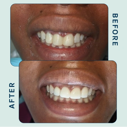 Smile Makeover